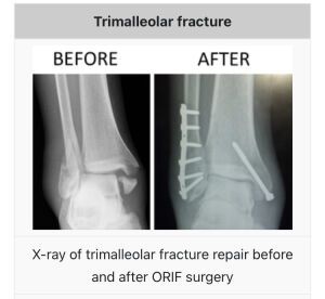 trimalleolar fracture